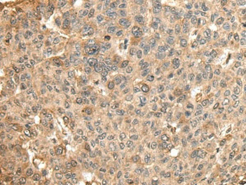Immunohistochemistry of paraffin-embedded Human liver cancer tissue using HMMR Polyclonal Antibody at dilution of 1:45(×200)