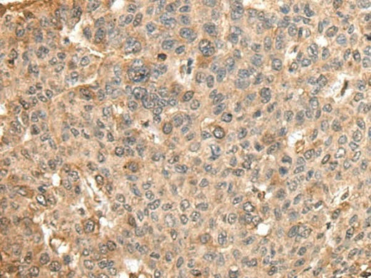 Immunohistochemistry of paraffin-embedded Human liver cancer tissue using HMMR Polyclonal Antibody at dilution of 1:45(×200)