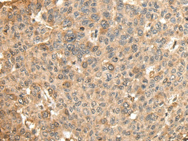 Immunohistochemistry of paraffin-embedded Human liver cancer tissue using HMMR Polyclonal Antibody at dilution of 1:45(×200)