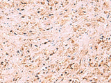 Immunohistochemistry of paraffin-embedded Human prost at e cancer tissue using ZSWIM1 Polyclonal Antibody at dilution of 1:95(×200)