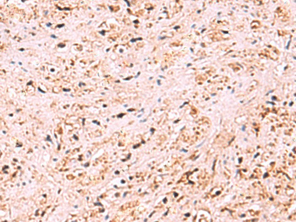 Immunohistochemistry of paraffin-embedded Human prost at e cancer tissue using ZSWIM1 Polyclonal Antibody at dilution of 1:95(×200)