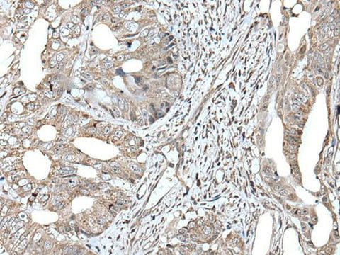 Immunohistochemistry of paraffin-embedded Human colorectal cancer tissue using RAD54B Polyclonal Antibody at dilution of 1:45(×200)