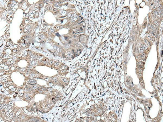 Immunohistochemistry of paraffin-embedded Human colorectal cancer tissue using RAD54B Polyclonal Antibody at dilution of 1:45(×200)