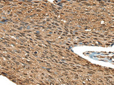 Immunohistochemistry of paraffin-embedded Human esophagus cancer tissue using CALML5 Polyclonal Antibody at dilution of 1:70(×200)