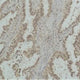 IHC staining of human lung carcinoma with P53 mono-methyl Lys370 antibody clone 4A1 at 1:500 dilution