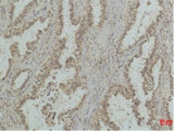 Immunohistochemistry of paraffin-embedded Human lung carcinoma tissue using P53 (Mono Methyl Lys370) Monoclonal Antibody at dilution of 1:500.