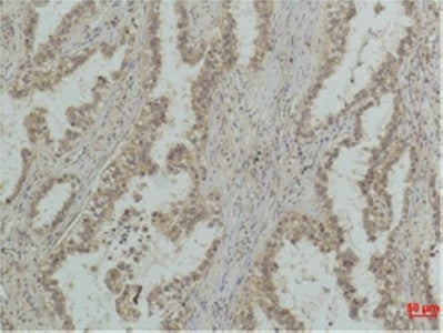 Immunohistochemistry of paraffin-embedded Human lung carcinoma tissue using P53 (Mono Methyl Lys370) Monoclonal Antibody at dilution of 1:500.