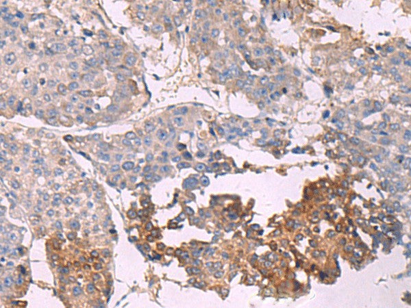 Immunohistochemistry of paraffin-embedded Human liver cancer tissue using NIPSNAP1 Polyclonal Antibody at dilution of 1:35(×200)