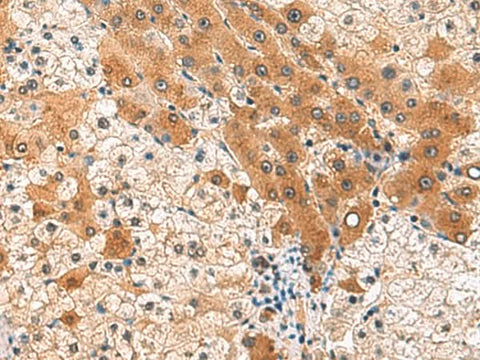 Immunohistochemistry of paraffin-embedded Human liver cancer tissue using PCYT2 Polyclonal Antibody at dilution of 1:85(×200)