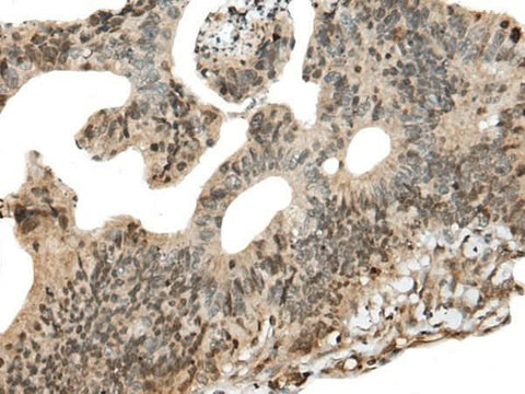 Immunohistochemistry of paraffin-embedded Human colorectal cancer tissue using CALML5 Polyclonal Antibody at dilution of 1:90(×200)