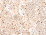 Immunohistochemistry of paraffin-embedded Human esophagus cancer tissue using IL7 Polyclonal Antibody at dilution of 1:30(×200)