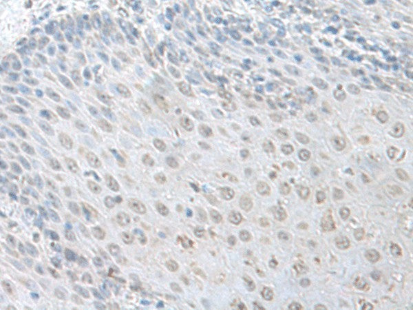 Immunohistochemistry of paraffin-embedded Human esophagus cancer tissue using LSM10 Polyclonal Antibody at dilution of 1:100(×200)