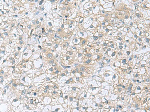 Immunohistochemistry of paraffin-embedded Human liver cancer tissue using TRO Polyclonal Antibody at dilution of 1:80(×200)