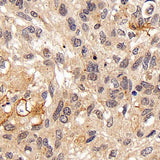 Immunohistochemistry analysis of paraffin-embedded human lung cancer using FOXO1 Polyclonal Antibody at dilution of 1:300.
