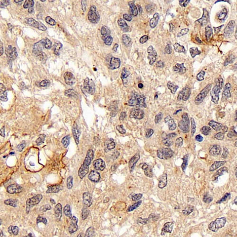 Immunohistochemistry analysis of paraffin-embedded human lung cancer using FOXO1 Polyclonal Antibody at dilution of 1:300.