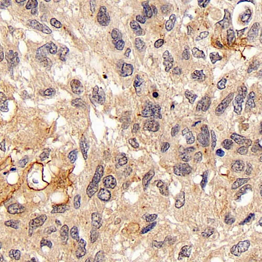 Immunohistochemistry analysis of paraffin-embedded human lung cancer using FOXO1 Polyclonal Antibody at dilution of 1:300.