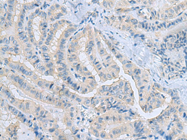 Immunohistochemistry of paraffin-embedded Human thyroid cancer tissue using MSI2 Polyclonal Antibody at dilution of 1:70(×200)