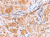 Immunohistochemistry of paraffin-embedded Human liver cancer tissue using IRGC Polyclonal Antibody at dilution of 1:30(×200)