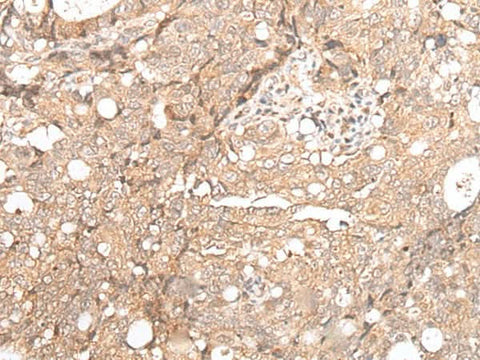 Immunohistochemistry of paraffin-embedded Human gastric cancer tissue using FOXO4 Polyclonal Antibody at dilution of 1:70(×200)