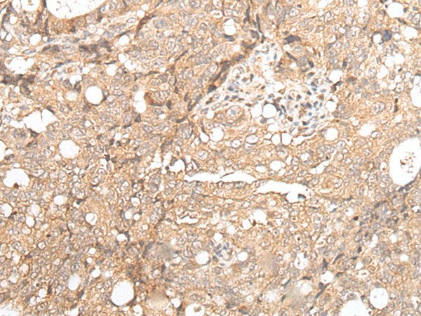 Immunohistochemistry of paraffin-embedded Human gastric cancer tissue using FOXO4 Polyclonal Antibody at dilution of 1:70(×200)