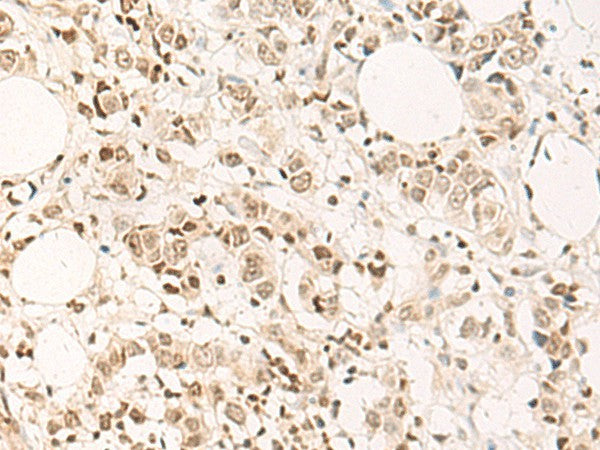 Immunohistochemistry of paraffin-embedded Human breast cancer tissue using DPPA4 Polyclonal Antibody at dilution of 1:55(×200)
