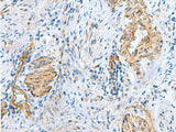 Immunohistochemistry of paraffin-embedded Human cervical cancer tissue using NMU Polyclonal Antibody at dilution of 1:60(×200)