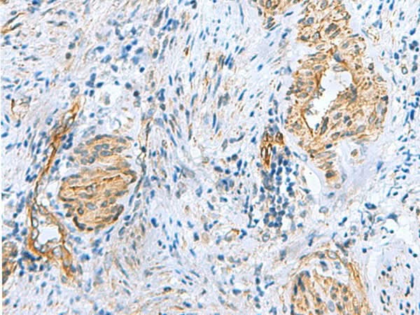 Immunohistochemistry of paraffin-embedded Human cervical cancer tissue using NMU Polyclonal Antibody at dilution of 1:60(×200)