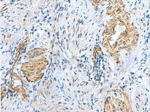 Immunohistochemistry of paraffin-embedded Human cervical cancer tissue using NMU Polyclonal Antibody at dilution of 1:60(×200)