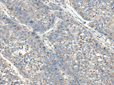 Immunohistochemistry of paraffin-embedded Human liver cancer tissue using XDH Polyclonal Antibody at dilution of 1:85(×200)