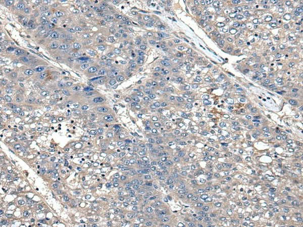 Immunohistochemistry of paraffin-embedded Human liver cancer tissue using XDH Polyclonal Antibody at dilution of 1:85(×200)
