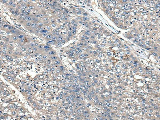 Immunohistochemistry of paraffin-embedded Human liver cancer tissue using XDH Polyclonal Antibody at dilution of 1:85(×200)