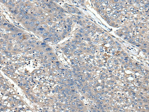 Immunohistochemistry of paraffin-embedded Human liver cancer tissue using XDH Polyclonal Antibody at dilution of 1:85(×200)