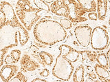 Immunohistochemistry of paraffin-embedded Human thyroid cancer tissue using PSPC1 Polyclonal Antibody at dilution of 1:25(×200)