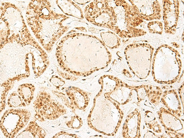 Immunohistochemistry of paraffin-embedded Human thyroid cancer tissue using PSPC1 Polyclonal Antibody at dilution of 1:25(×200)