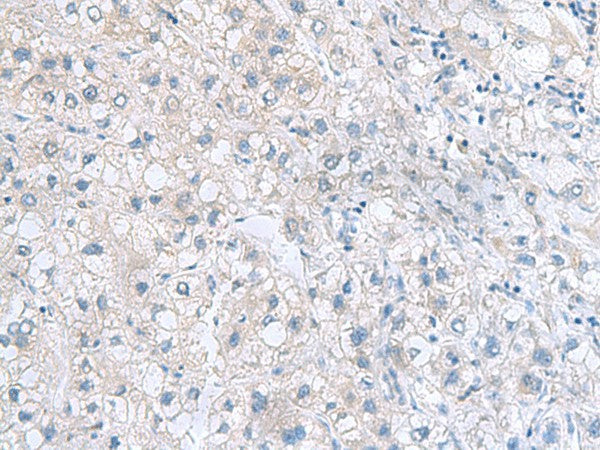 Immunohistochemistry of paraffin-embedded Human liver cancer tissue using MYDGF Polyclonal Antibody at dilution of 1:70(×200)