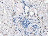 Immunohistochemistry of paraffin-embedded Human thyroid cancer tissue using PTP4A1 Polyclonal Antibody at dilution of 1:45(×200)