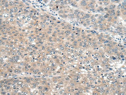 Immunohistochemistry of paraffin-embedded Human liver cancer tissue using SEMA4D Polyclonal Antibody at dilution of 1:60(×200)