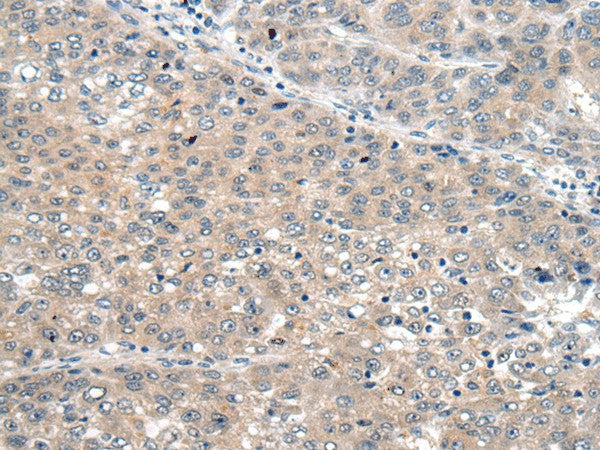 Immunohistochemistry of paraffin-embedded Human liver cancer tissue using SEMA4D Polyclonal Antibody at dilution of 1:60(×200)