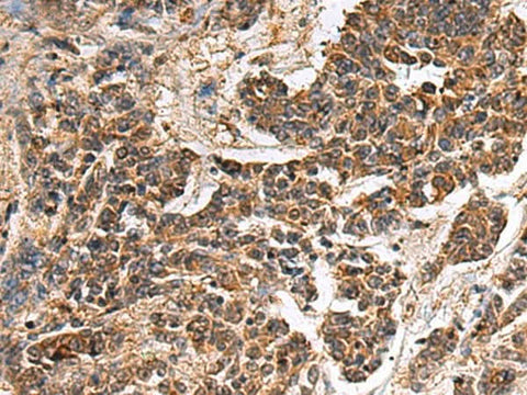 Immunohistochemistry of paraffin-embedded Human colorectal cancer tissue using GANAB Polyclonal Antibody at dilution of 1:30(×200)