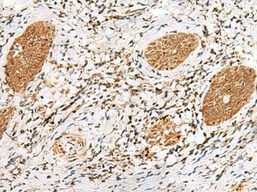Immunohistochemistry of paraffin-embedded Human esophagus cancer tissue using NUP58 Polyclonal Antibody at dilution of 1:60(×200)