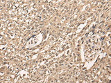 Immunohistochemistry of paraffin-embedded Human lung cancer tissue using ATF7 Polyclonal Antibody at dilution of 1:40(×200)