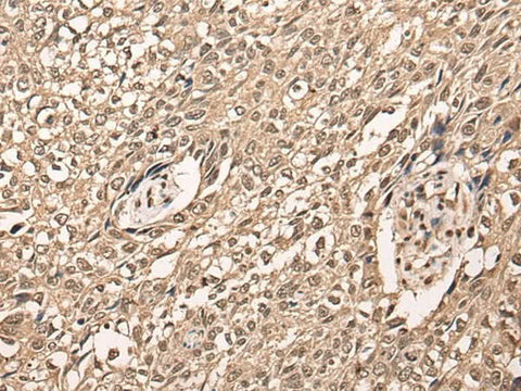 Immunohistochemistry of paraffin-embedded Human lung cancer tissue using ATF7 Polyclonal Antibody at dilution of 1:40(×200)