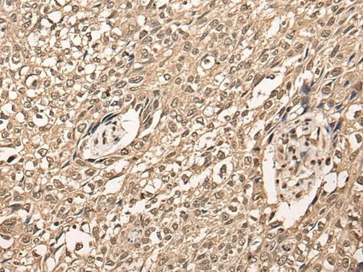 Immunohistochemistry of paraffin-embedded Human lung cancer tissue using ATF7 Polyclonal Antibody at dilution of 1:40(×200)