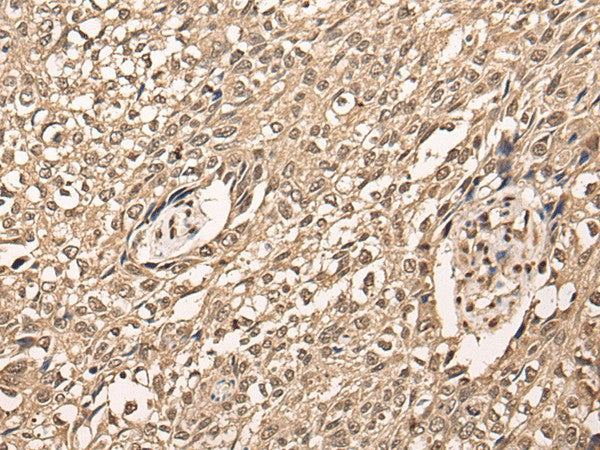 Immunohistochemistry of paraffin-embedded Human lung cancer tissue using ATF7 Polyclonal Antibody at dilution of 1:40(×200)