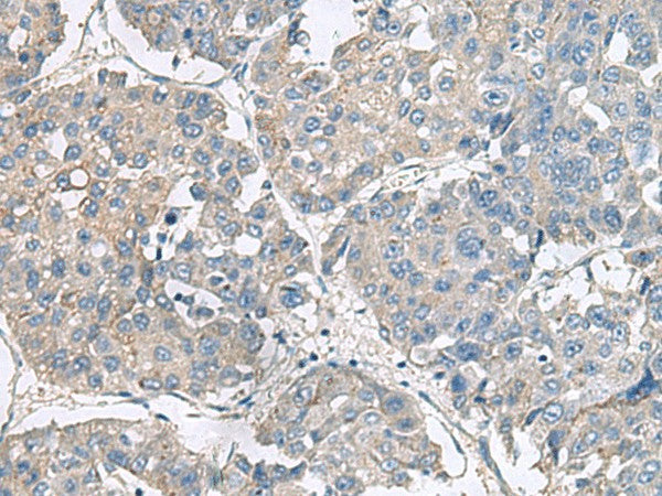 Immunohistochemistry of paraffin-embedded Human liver cancer tissue using NPHP1 Polyclonal Antibody at dilution of 1:75(×200)