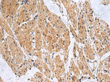 Immunohistochemistry of paraffin-embedded Human esophagus cancer tissue using SLC4A3 Polyclonal Antibody at dilution of 1:35(×200)