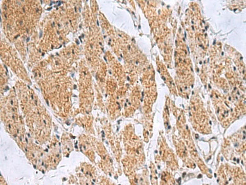 Immunohistochemistry of paraffin-embedded Human esophagus cancer tissue using SLC4A3 Polyclonal Antibody at dilution of 1:35(×200)