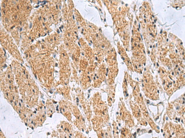 Immunohistochemistry of paraffin-embedded Human esophagus cancer tissue using SLC4A3 Polyclonal Antibody at dilution of 1:35(×200)