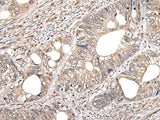 Immunohistochemistry of paraffin-embedded Human colorectal cancer tissue using GCNT2 Polyclonal Antibody at dilution of 1:60(×200)