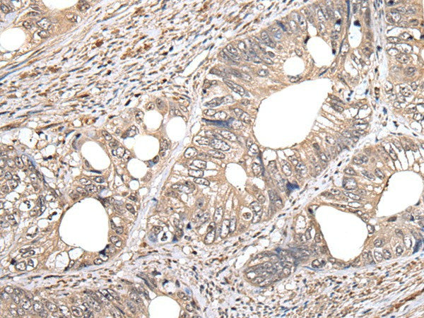 Immunohistochemistry of paraffin-embedded Human colorectal cancer tissue using GCNT2 Polyclonal Antibody at dilution of 1:60(×200)